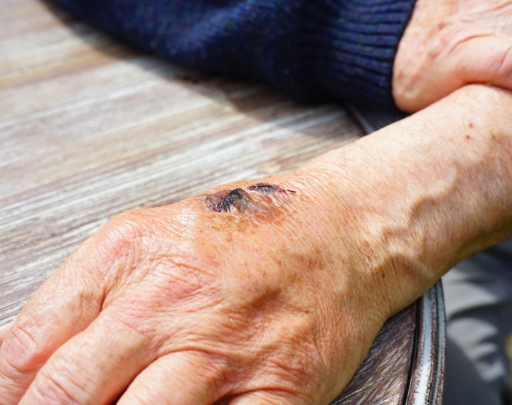 Wound on hand