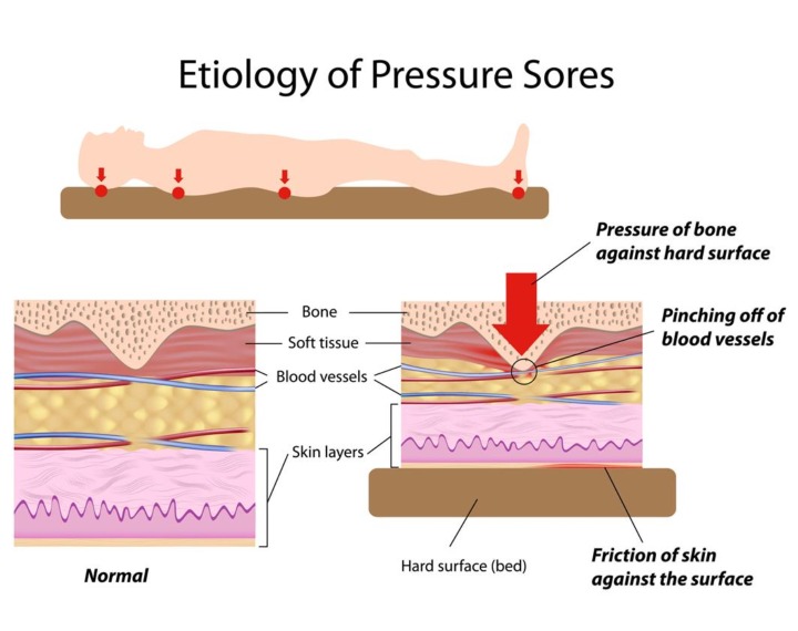 Pressure ulcer diagram